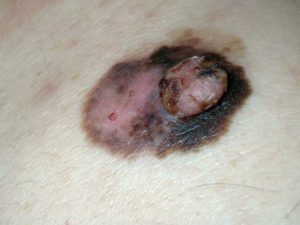 Рак кожи симптомы меланомы на фото.