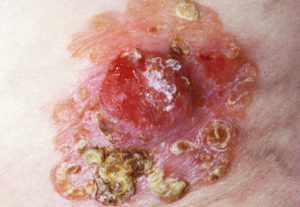 Плоскоклеточны рак кожи - симптомы на фото.