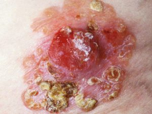 Плоскоклеточный рак кожи - симптомы на фото.