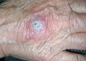 На фото симптомы плоскоклеточного рака кожи.