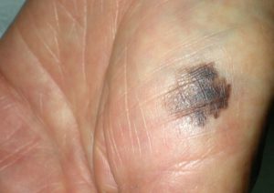 На фото акральная лентигинозная меланома в виде пятна с неровными контурами и неравномерной окраской.
