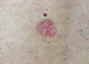 На фото базальноклеточный рак кожи с краями, которые выглядят как валик.