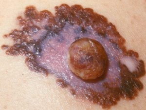 Рак кожи типа меланомы на фото выглядит как шишка из коричневого пятна