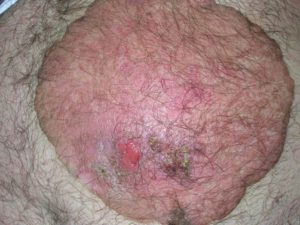 Плоскоклеточный рак кожи на фото из Болезни Боуэна.