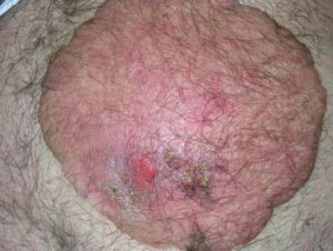 Плоскоклеточный рак кож на фото из Болезни Боуэна.