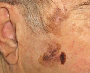 Рак кожи начальной стадии - лентиго-меланома на фото.