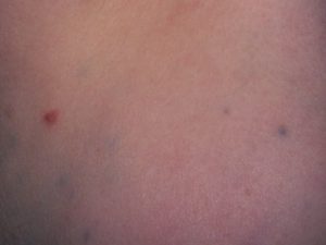 На фото метастазы меланомы под кожей, четвертая стадия.