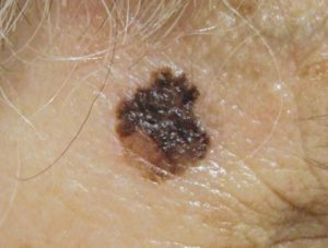 Рак кожи на лице - на фото поверхностная меланома.
