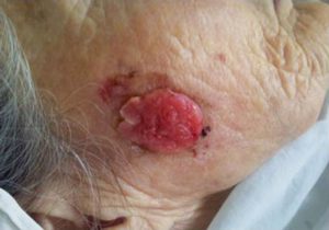 На фото рак кожи на лице плоскоклеточный неороговевающий.