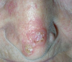 На фото рак кожи лица - начальная стадия плоскоклеточного ороговевающего.