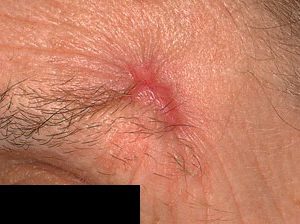 Рак кожи лица на фото, поверхностный базальноклеточный.