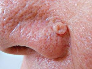 На фото рак кожи лица базальноклеточный, узловой, в начальной стадии.