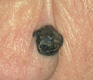 Рак кожи на лице - на фото узловая меланома.