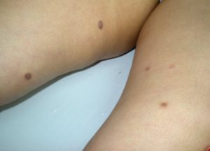 Дерматофибромы - на фото твердые наросты в коже ног.