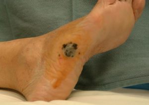 На ноге пятно с мелкимиочагами вокруг - меланома 3 стадии