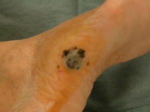 На ноге пятно с мелкими очагами вокруг - меланома 3 стадии